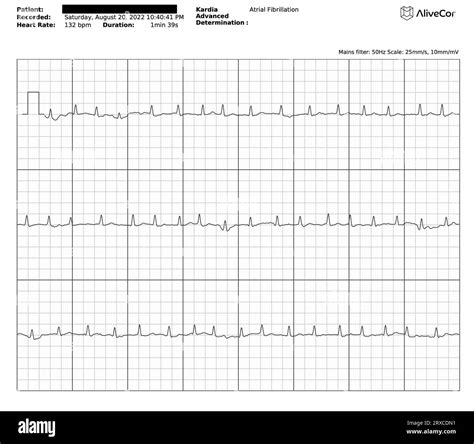 an irregular heartbeat figgerits answers|Atrial fibrillation .